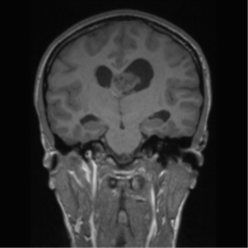 Central neurocytoma (Radiopaedia 37664-39557 Coronal T1 44).png