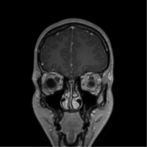 Central neurocytoma (Radiopaedia 37664-39557 Coronal T1 C+ 72).png