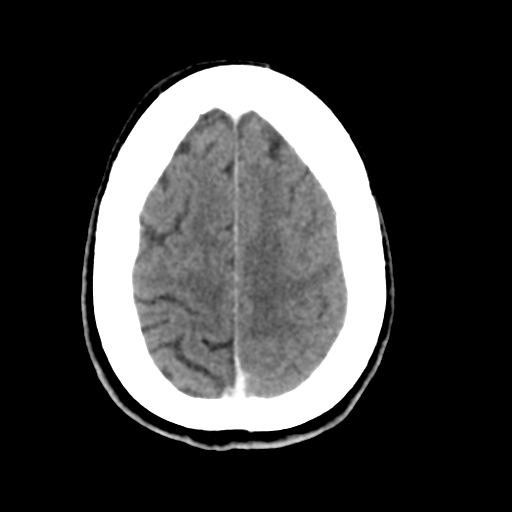 Central neurocytoma (Radiopaedia 65317-74346 Axial C+ delayed 41).png