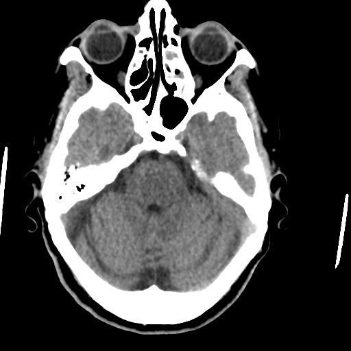 Central neurocytoma (Radiopaedia 65317-74346 Axial non-contrast 15).png