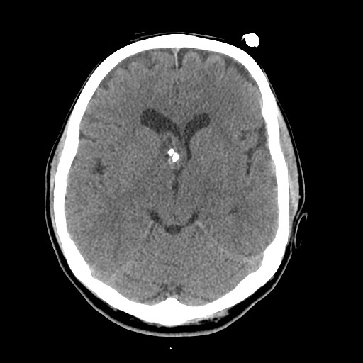 Central neurocytoma (Radiopaedia 68725-78432 Axial non-contrast 22).jpg
