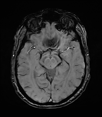 File:Central neurocytoma (Radiopaedia 71068-81303 Axial SWI 26).jpg