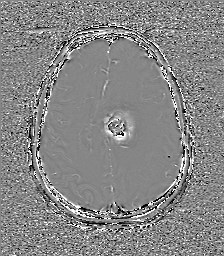 Central neurocytoma (Radiopaedia 84497-99872 Axial 50).jpg