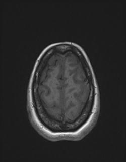 File:Central neurocytoma (Radiopaedia 84497-99872 Axial T1 165).jpg