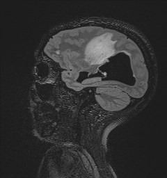 Central neurocytoma (Radiopaedia 84497-99872 Sagittal Flair + Gd 107).jpg