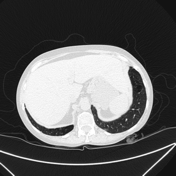 Centrilobular pulmonary emphysema (Radiopaedia 24495-24789 Axial lung window 85).jpg