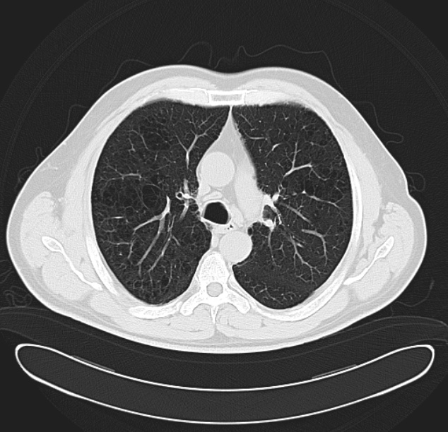 Centrilobular pulmonary emphysema (Radiopaedia 26808-26971 C 17).jpg