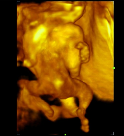 File:Cephalopagus conjoined twin (4D ultrasound) (Radiopaedia 84793-100256 Transverse 1).jpg