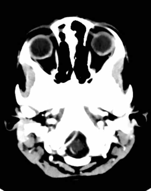 Cerebellar abscess (Radiopaedia 73727-84527 Axial C+ 7).jpg