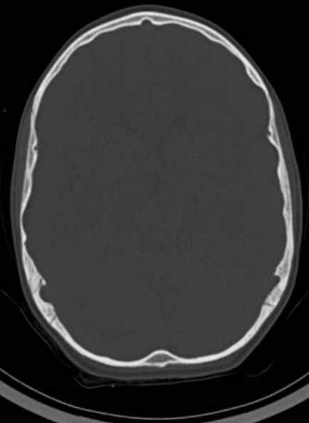 File:Cerebellar abscess (Radiopaedia 73727-84527 Axial bone window 34).jpg