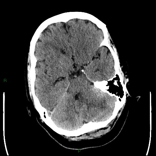 Cerebellar abscess (Radiopaedia 78135-90671 Axial non-contrast 37).jpg