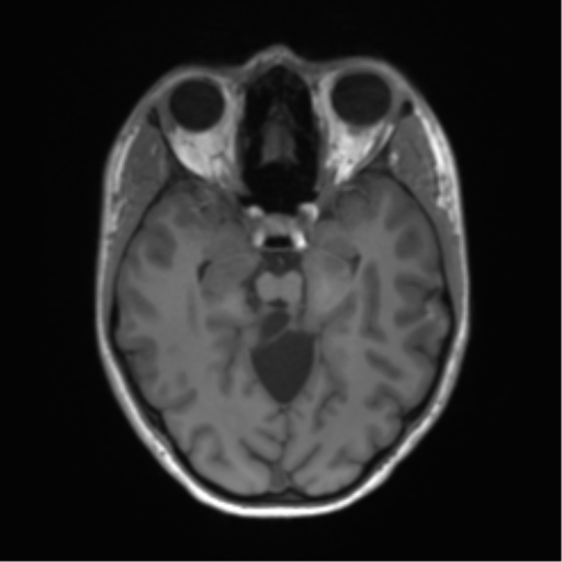 Cerebellar agenesis with hypoplastic pons (pontocerebellar hypoplasia) (Radiopaedia 57224-64138 Axial T1 30).png