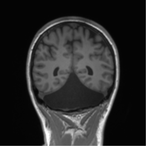Cerebellar agenesis with hypoplastic pons (pontocerebellar hypoplasia) (Radiopaedia 57224-64138 Coronal T1 29).png
