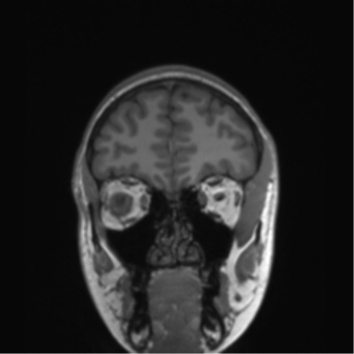 Cerebellar agenesis with hypoplastic pons (pontocerebellar hypoplasia) (Radiopaedia 57224-64138 Coronal T1 75).png