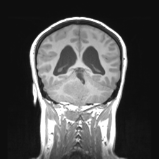 Cerebellar ependymoma complicated by post-operative subdural hematoma (Radiopaedia 83322-97736 Coronal T1 38).png