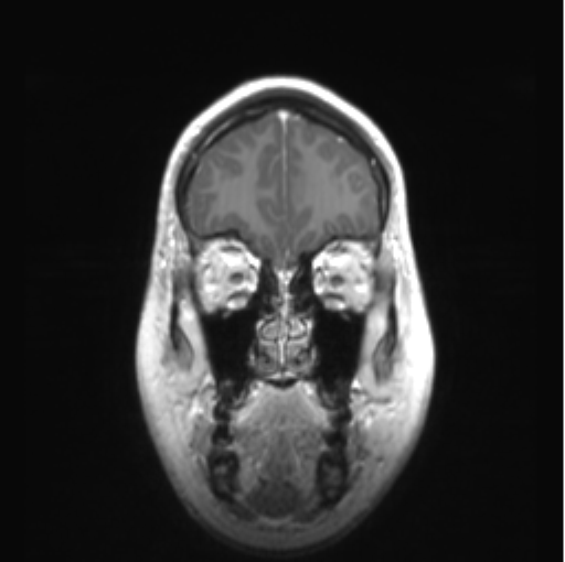 Cerebellar ependymoma complicated by post-operative subdural hematoma (Radiopaedia 83322-97736 Coronal T1 C+ 10).png