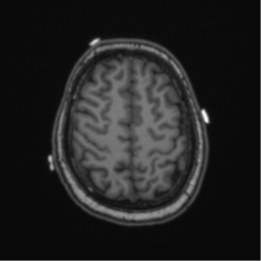 Cerebellar hemangioblastomas and pituitary adenoma (Radiopaedia 85490-101176 Axial T1 58).png