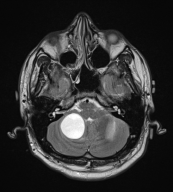 File:Cerebellar hemangioblastomas and pituitary adenoma (Radiopaedia 85490-101176 Axial T2 8).png