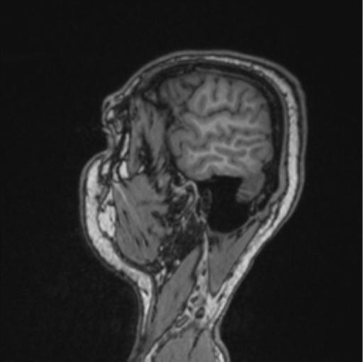 Cerebellar hemangioblastomas and pituitary adenoma (Radiopaedia 85490-101176 Sagittal T1 79).png