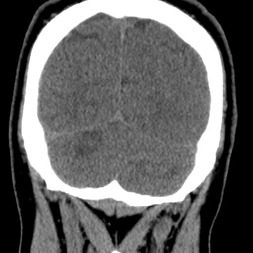 Cerebellar infarction (Radiopaedia 16625-16327 Coronal non-contrast 36).jpg