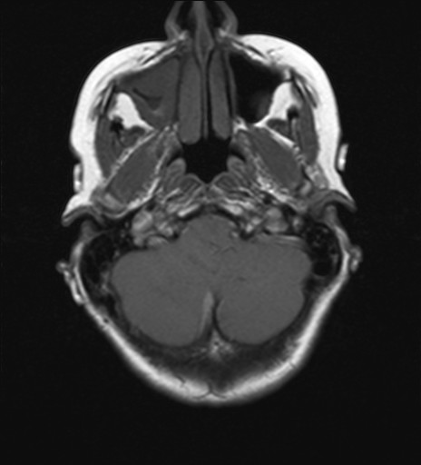 File:Cerebellar metastases (Radiopaedia 24038-24249 Axial T1 15).jpg