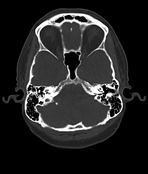 Cerebellar metastases - colorectal adenocarcinoma (Radiopaedia 40947-43652 AX Bone C- 2.0 MPR 12).png