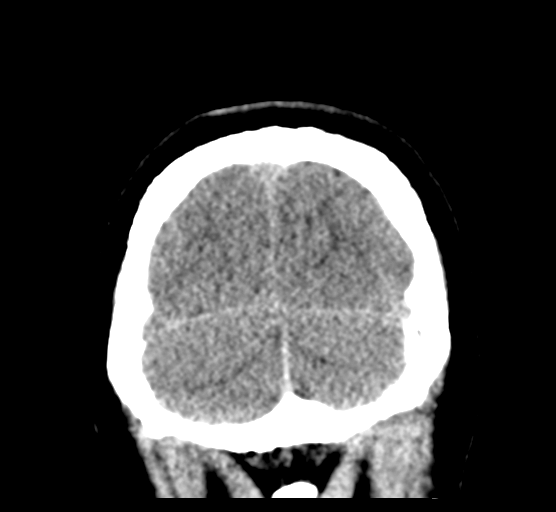 Cerebellar metastases - colorectal adenocarcinoma (Radiopaedia 40947-43652 Coronal non-contrast 83).png