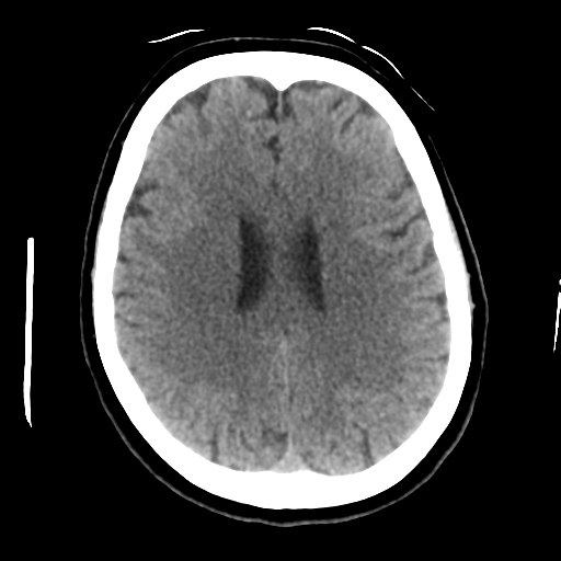 Cerebellar metastasis (cystic appearance) (Radiopaedia 41395-44258 Axial non-contrast 35).png