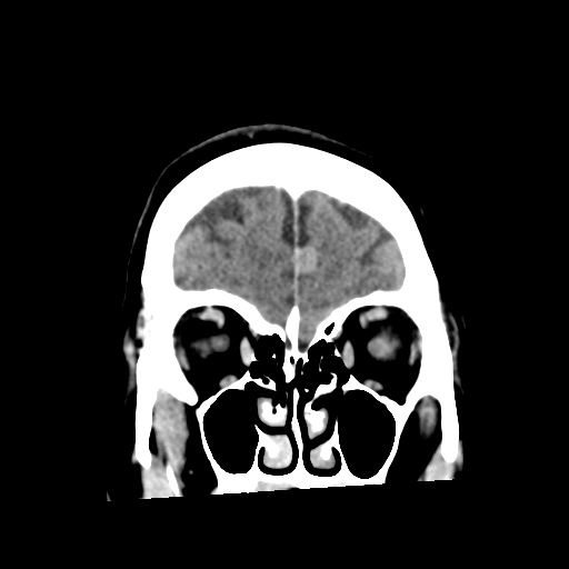 Cerebellar metastasis (cystic appearance) (Radiopaedia 41395-44258 D 14).png