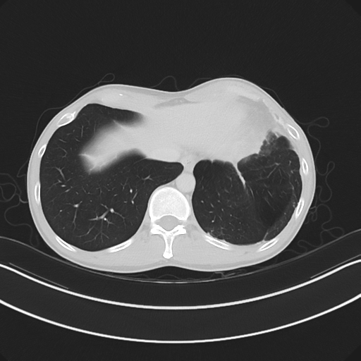 Cerebellar metastasis - adenocarcinoma lung (Radiopaedia 63184-71717 Axial lung window 57).png