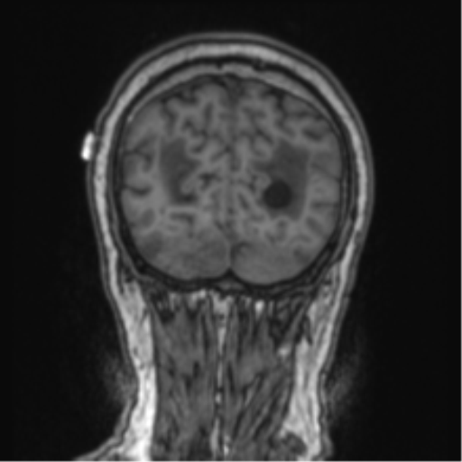 Cerebellar metastasis from lung adenocarcinoma (Radiopaedia 86690-102829 Coronal T1 18).png