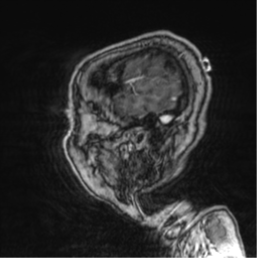 Cerebellar metastasis from lung adenocarcinoma (Radiopaedia 86690-102829 Sagittal T1 C+ 72).png