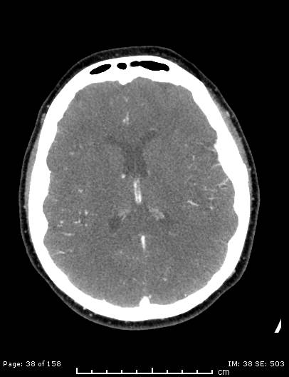 Cerebellar strokes due to intracranial giant cell arteritis (Radiopaedia 68799-78510 CT angiogram 38).jpg