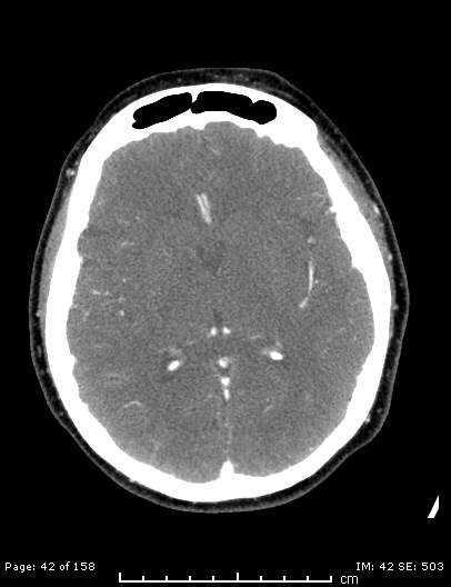Cerebellar strokes due to intracranial giant cell arteritis (Radiopaedia 68799-78510 CT angiogram 42).jpg