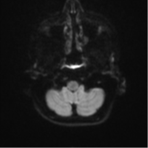 Cerebellar tuberculomas (Radiopaedia 46939-51472 Axial DWI 32).png