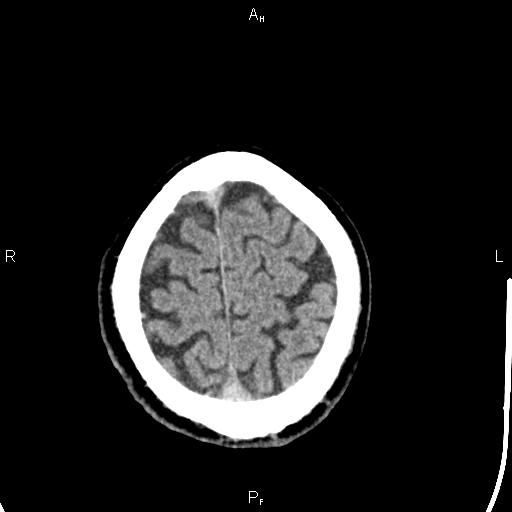 File:Cerebellopontine angle arachnoid cyst (Radiopaedia 85149-100704 Axial With contrast 46).jpg