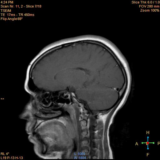 File:Cerebellopontine angle meningioma (Radiopaedia 22488-22525 Sagittal T1 C+ 7).jpg