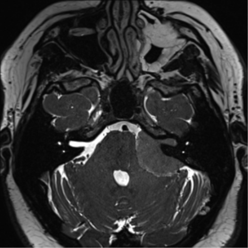 Cerebellopontine angle meningioma (Radiopaedia 48434-53348 Axial T2 Space 60).png