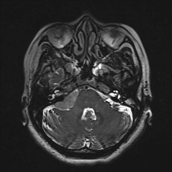 Cerebellopontine angle meningioma (Radiopaedia 53561-59591 Axial 3D volume T2 55).jpg