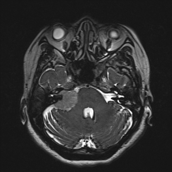 Cerebellopontine angle meningioma (Radiopaedia 53561-59591 Axial 3D volume T2 62).jpg