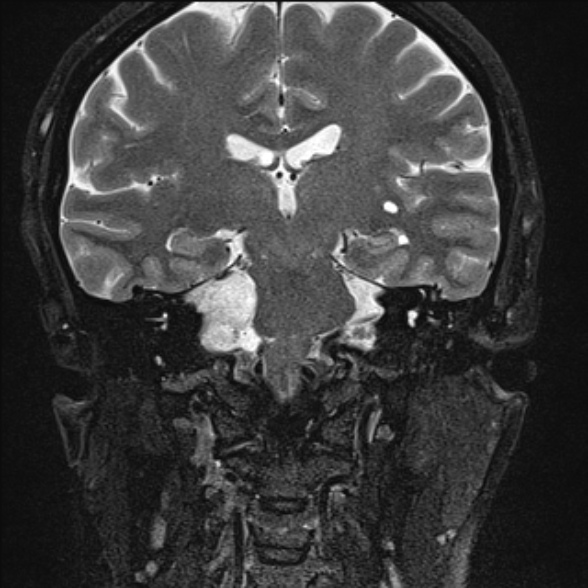 File:Cerebellopontine angle meningioma (Radiopaedia 53561-59591 Coronal T2 13).jpg