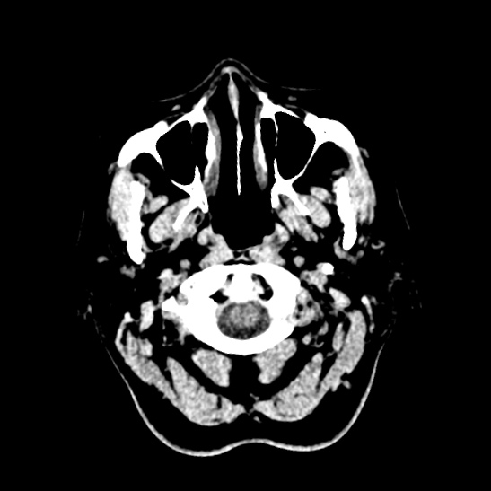 Cerebellopontine angle meningioma (Radiopaedia 53561-59592 Axial non-contrast 2).jpg