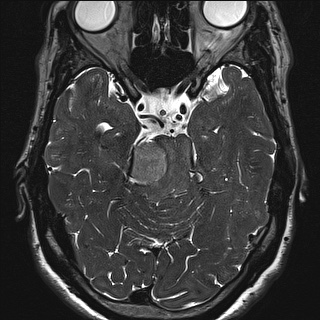 Cerebellopontine angle meningioma (Radiopaedia 72983-83680 Axial FIESTA 55).jpg
