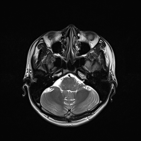 Cerebral abscess (Radiopaedia 24212-24478 Axial T2 18).jpg