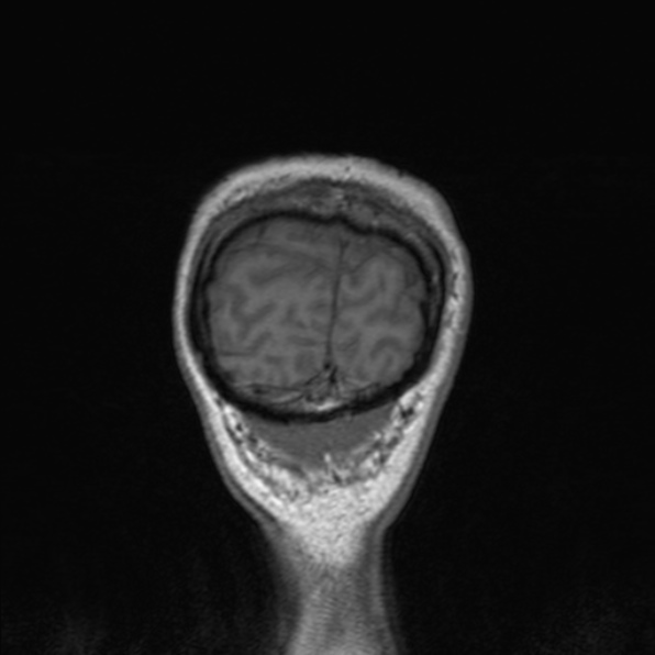 Cerebral abscess (Radiopaedia 24212-24478 Coronal T1 183).jpg