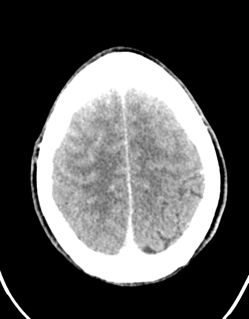 Cerebral abscess (Radiopaedia 60342-68008 Axial C+ delayed 42).png
