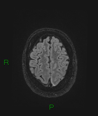 Cerebral abscess and subdural empyema (Radiopaedia 84436-99779 Axial FLAIR 18).jpg