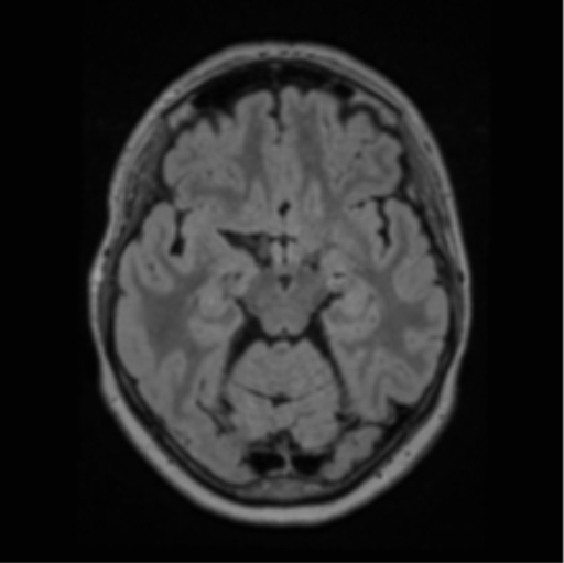 File:Cerebral abscess from pulmonary arteriovenous malformation (Radiopaedia 86275-102291 J 32).png
