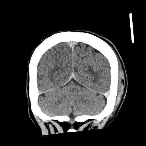 Cerebral amyloid angiopathy-related inflammation (Radiopaedia 74836-85848 Coronal non-contrast 57).jpg