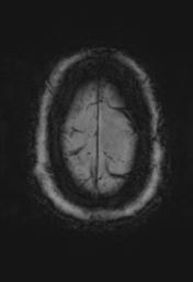 File:Cerebral amyloid angiopathy (Radiopaedia 29129-29518 Axial SWI MPR 35).jpg